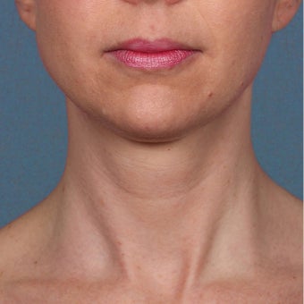 35-44 year old woman treated with Kybella after 2224857