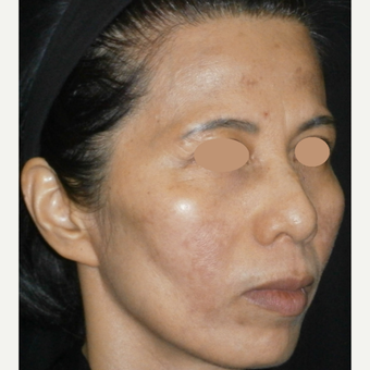 45-54 year old woman treated with Laser Treatment after 3089570