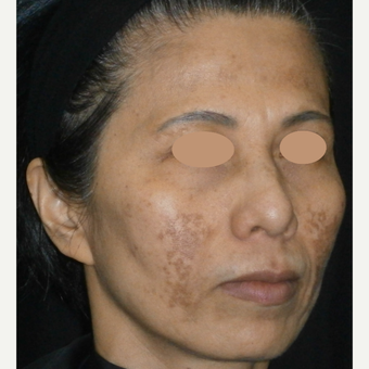 45-54 year old woman treated with Laser Treatment before 3089570