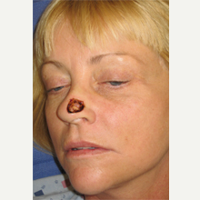 35-44 year old woman treated with Mohs Surgery before 3389167