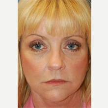 35-44 year old woman treated with Mohs Surgery after 3389167