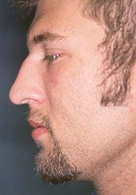 Male Rhinoplasty 979805