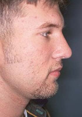 Male Rhinoplasty after 979805