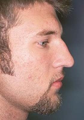 Male Rhinoplasty before 979805