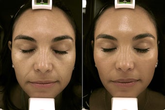 38 year old woman treated with Restylane for infraorbital hollows and nasolabial folds before 679309