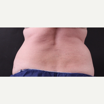 62 year old woman treated with CoolSculpting after 3221073