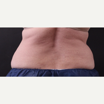 62 year old woman treated with CoolSculpting before 3221073