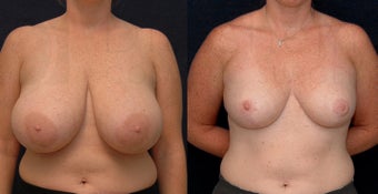 Breast Reduction before 1141906