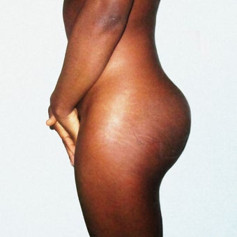 25 year old female getting butt implants after 1172586