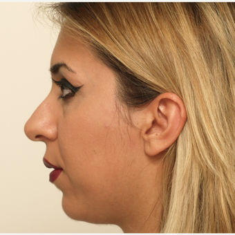 25-34 year old woman treated with Rhinoplasty before 3406444