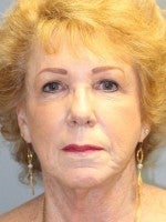 65-74 year old woman treated with Neck Lift before 3103933