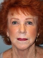 65-74 year old woman treated with Neck Lift after 3103933