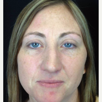 25-34 year old woman treated with Rhinoplasty before 3525983