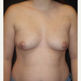 18-24 year old woman treated with Breast Implants before 3458273