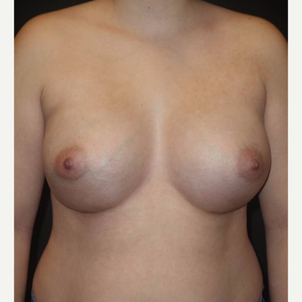 18-24 year old woman treated with Breast Implants after 3458273