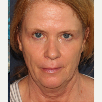 45-54 year old woman treated with Belotero after 3230342