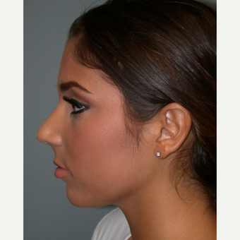 18-24 year old woman treated with Rhinoplasty after 3685188