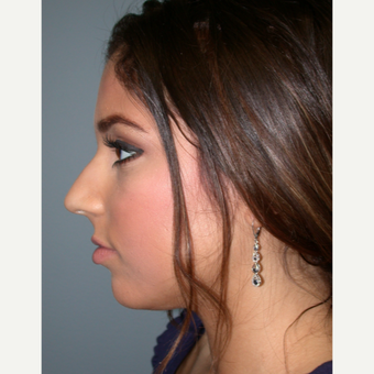 18-24 year old woman treated with Rhinoplasty before 3685188