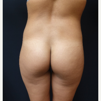 25-34 year old woman treated with 548cc Round Silicone Butt Implants for her Augmentation before 3043071