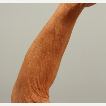 62 year old woman treated left arm with microneedling and DefenAge post-treatment serum before 3419599