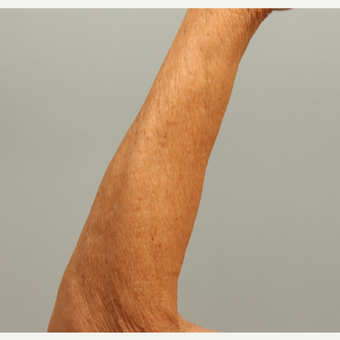62 year old woman treated left arm with microneedling and DefenAge post-treatment serum after 3419599