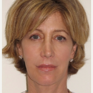 45-54 year old woman treated with Injectable Fillers and Ultherapy after 3137207