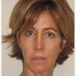 45-54 year old woman treated with Injectable Fillers and Ultherapy before 3137207