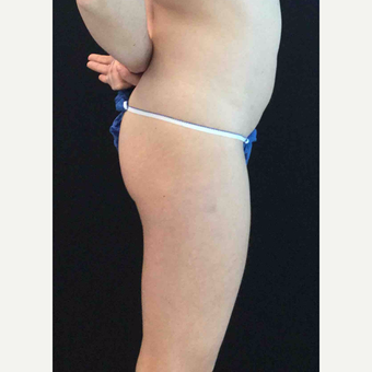 25-34 year old woman treated with Brazilian Butt Lift before 3064652