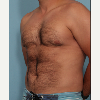 35-44 year old man treated with Fat Transfer after 3589443