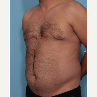 35-44 year old man treated with Fat Transfer before 3589443