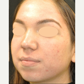 17 or under year old woman treated with Acne Treatment after 3398311