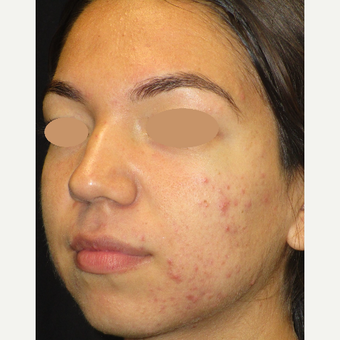 17 or under year old woman treated with Acne Treatment before 3398311