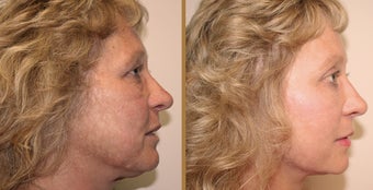 Mini Face Lift before 1165746