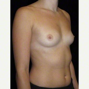 24 year old woman treated with Breast Augmentation before 3103649