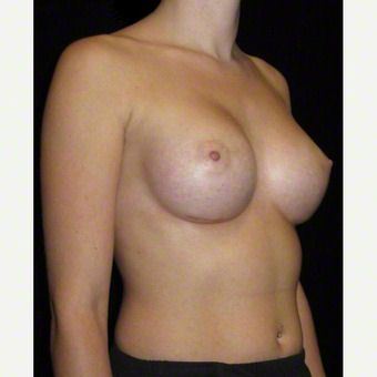 24 year old woman treated with Breast Augmentation after 3103649