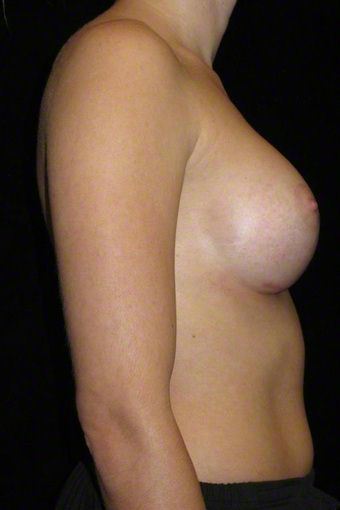 24 year old woman treated with Breast Augmentation 3103649