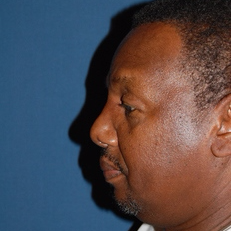55-64 year old man treated with African American Rhinoplasty before 3294324