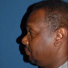 55-64 year old man treated with African American Rhinoplasty after 3294324