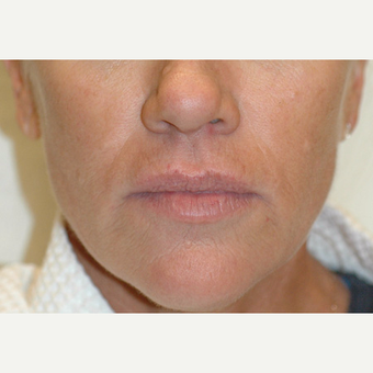 Sculptra Injections Before and After after 3103509