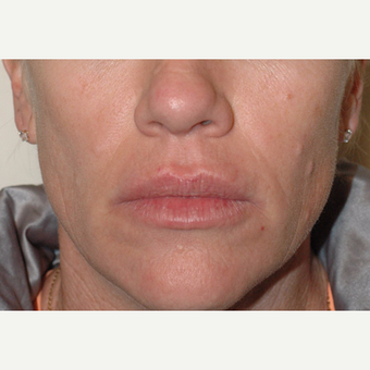 Sculptra Injections Before and After before 3103509
