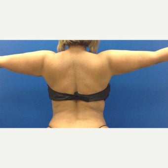 35-44 year old woman treated with Liposculpture of Arms, bra rolls, waist after 1984417