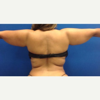35-44 year old woman treated with Liposculpture of Arms, bra rolls, waist before 1984417