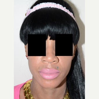 25-34 year old woman treated with Rhinoplasty before 1696240