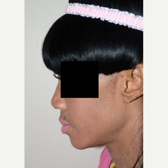 25-34 year old woman treated with Rhinoplasty 1696240