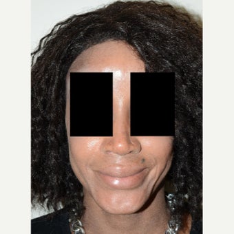 25-34 year old woman treated with Rhinoplasty after 1696240