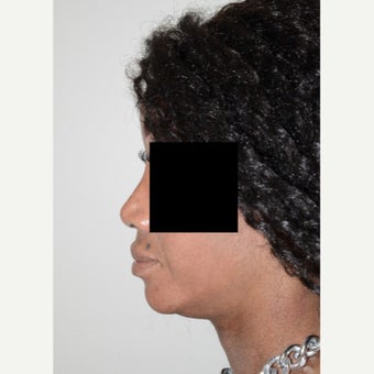 25-34 year old woman treated with Rhinoplasty 1696240