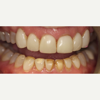 45-54 year old woman treated with Porcelain Veneers before 3432686