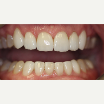 45-54 year old woman treated with Porcelain Veneers after 3432686