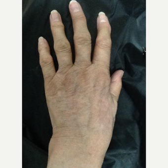 75 and up year old woman treated with Radiesse for hand rejuvenation after 3287069