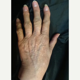 75 and up year old woman treated with Radiesse for hand rejuvenation before 3287069